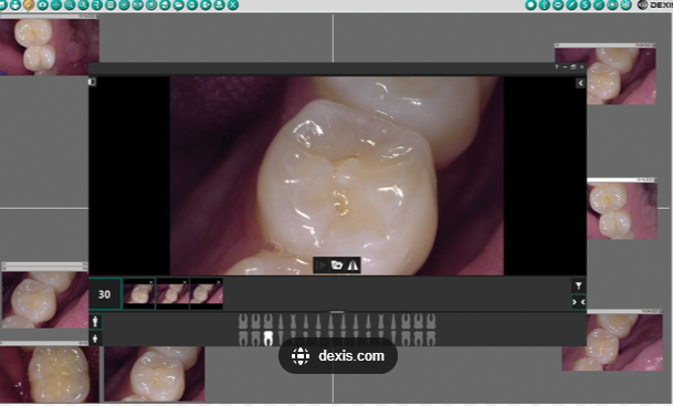 Intraoral camera